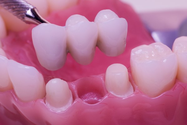 Fixed Dentistry For Dental Restoration &#    ; Dental Bridges